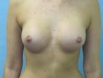 Breast Augmentation - Case 41 - After
