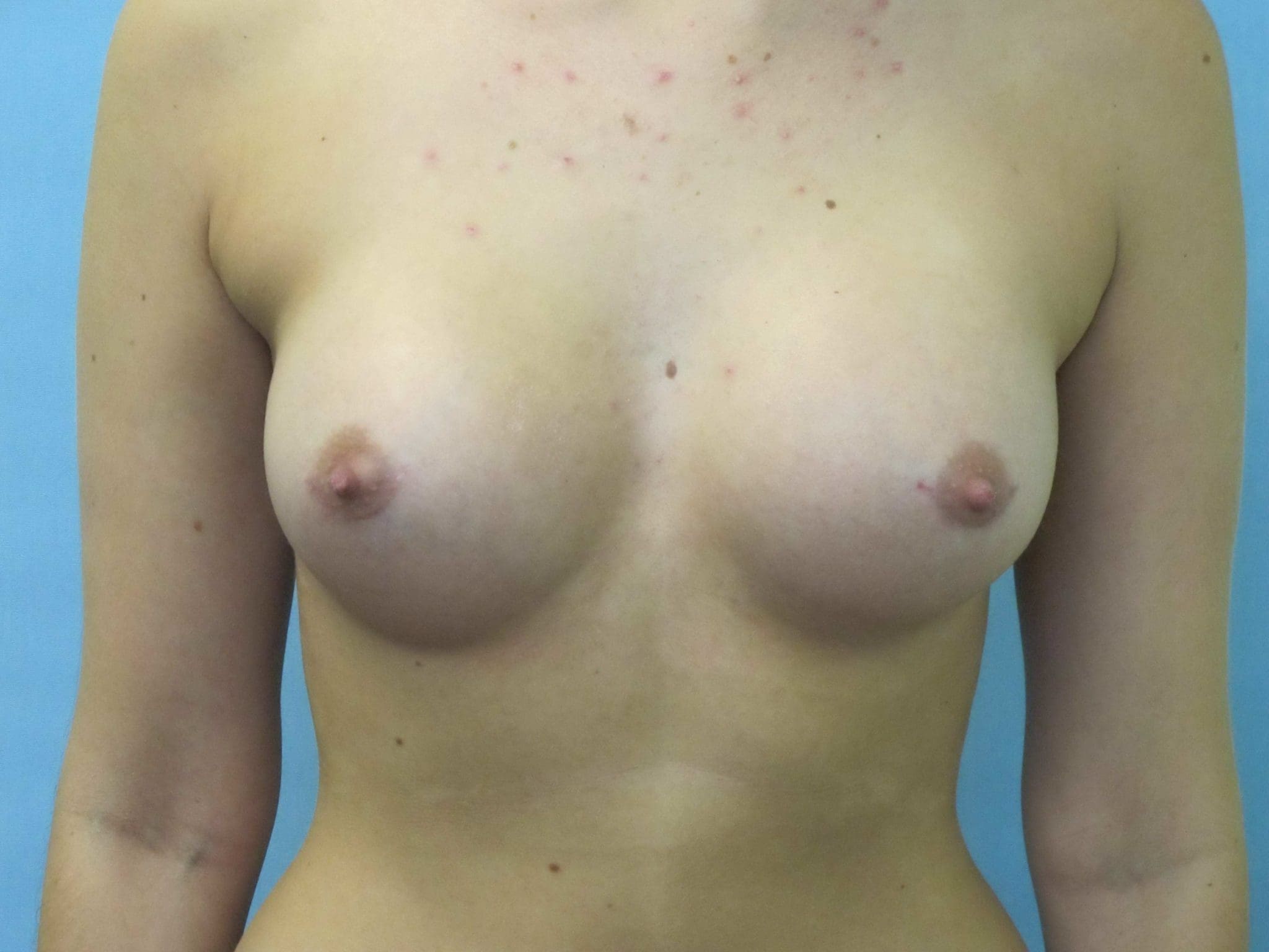 Breast Augmentation Patient Photo - Case 41 - after view