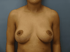 Breast Lift Patient Photo - Case 169 - after view