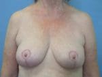 Breast Lift - Case 72 - After