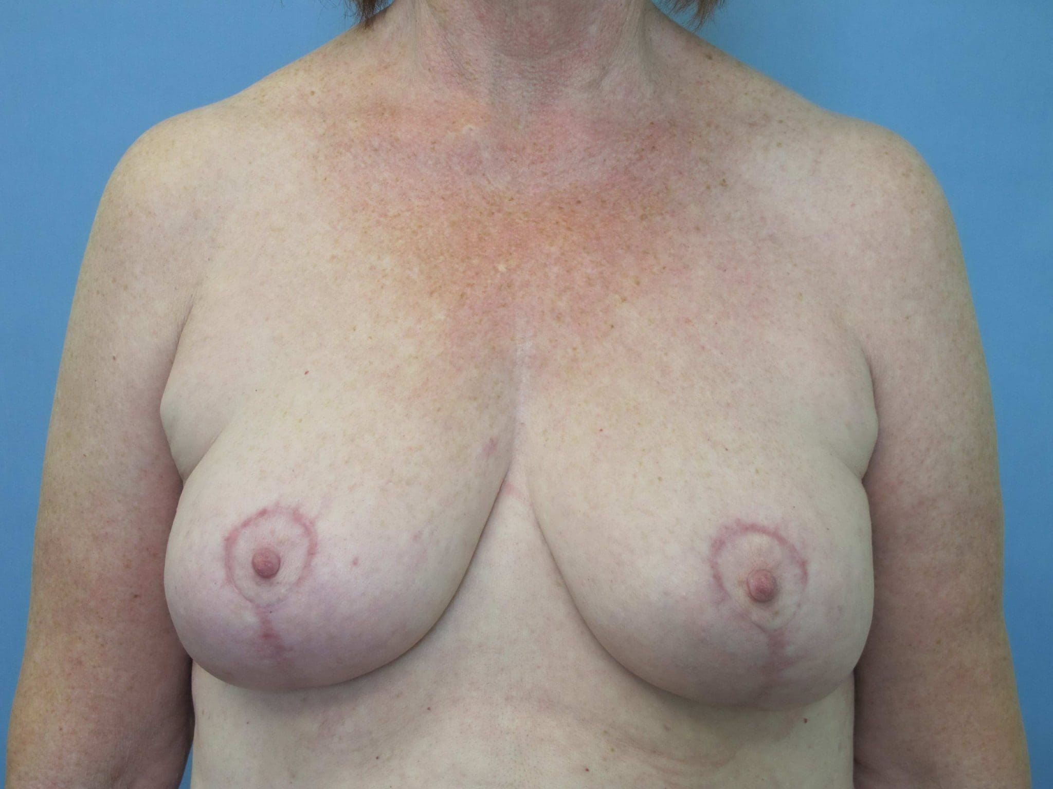 Breast Reduction Patient Photo - Case 72 - after view