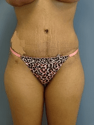 Tummy Tuck Patient Photo - Case 166 - after view