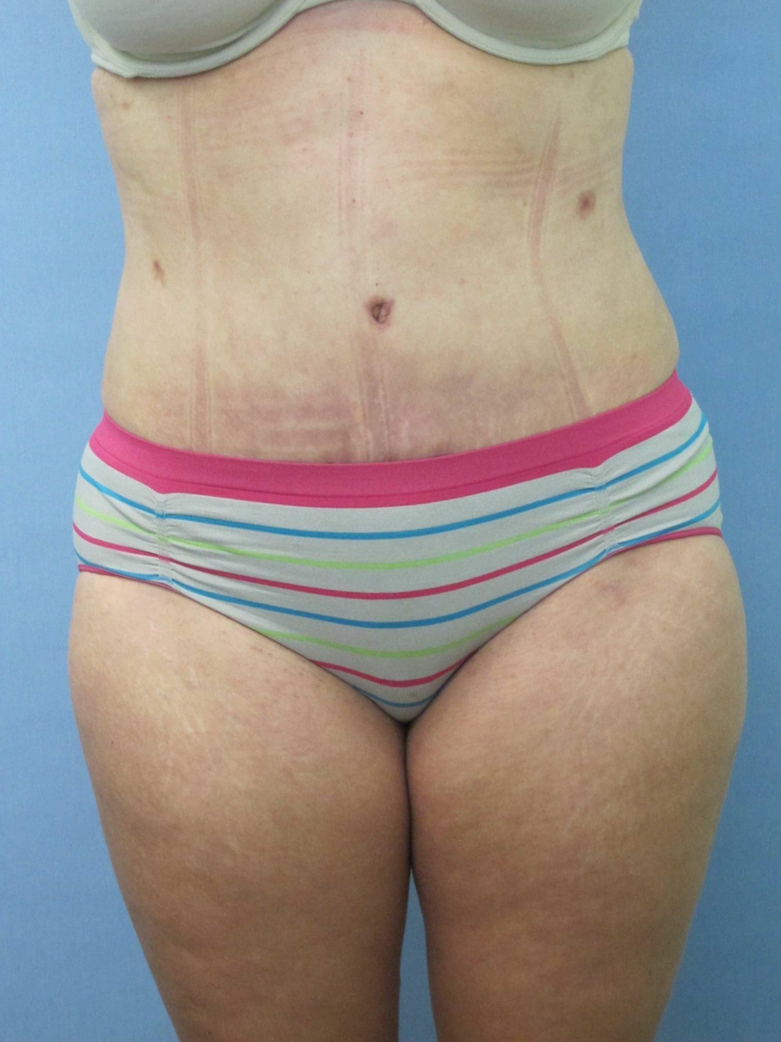 Tummy Tuck Patient Photo - Case 154 - after view
