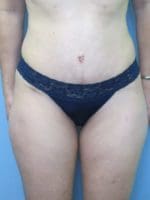 Liposuction - Case 115 - After