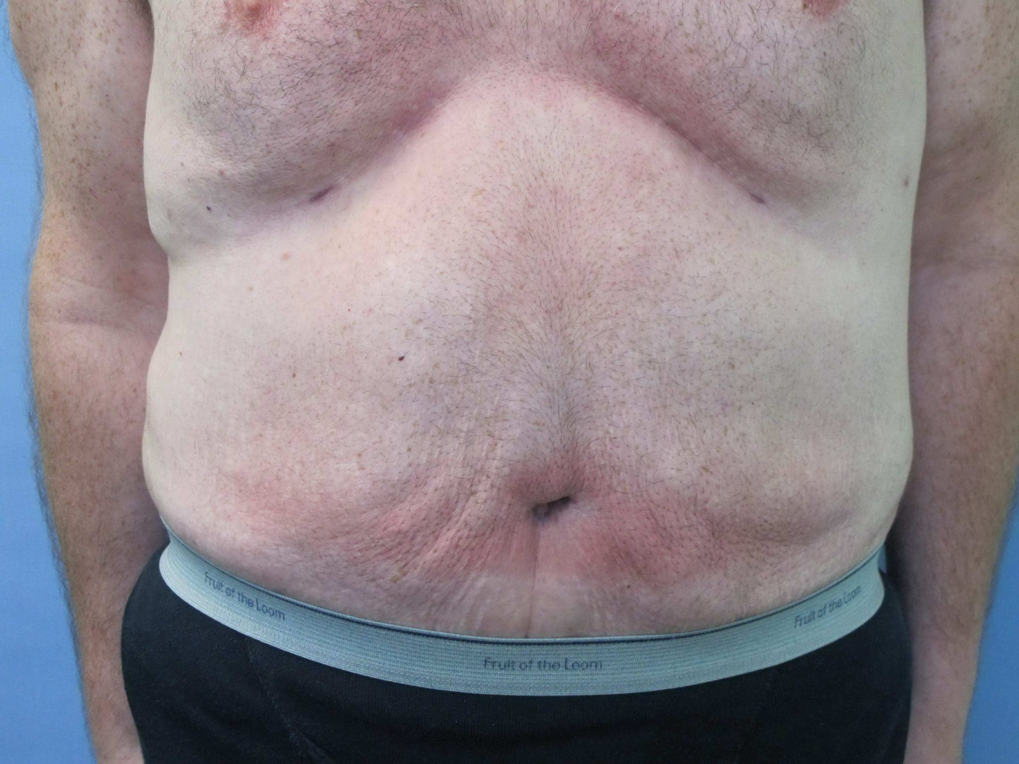 Liposuction Patient Photo - Case 76 - after view