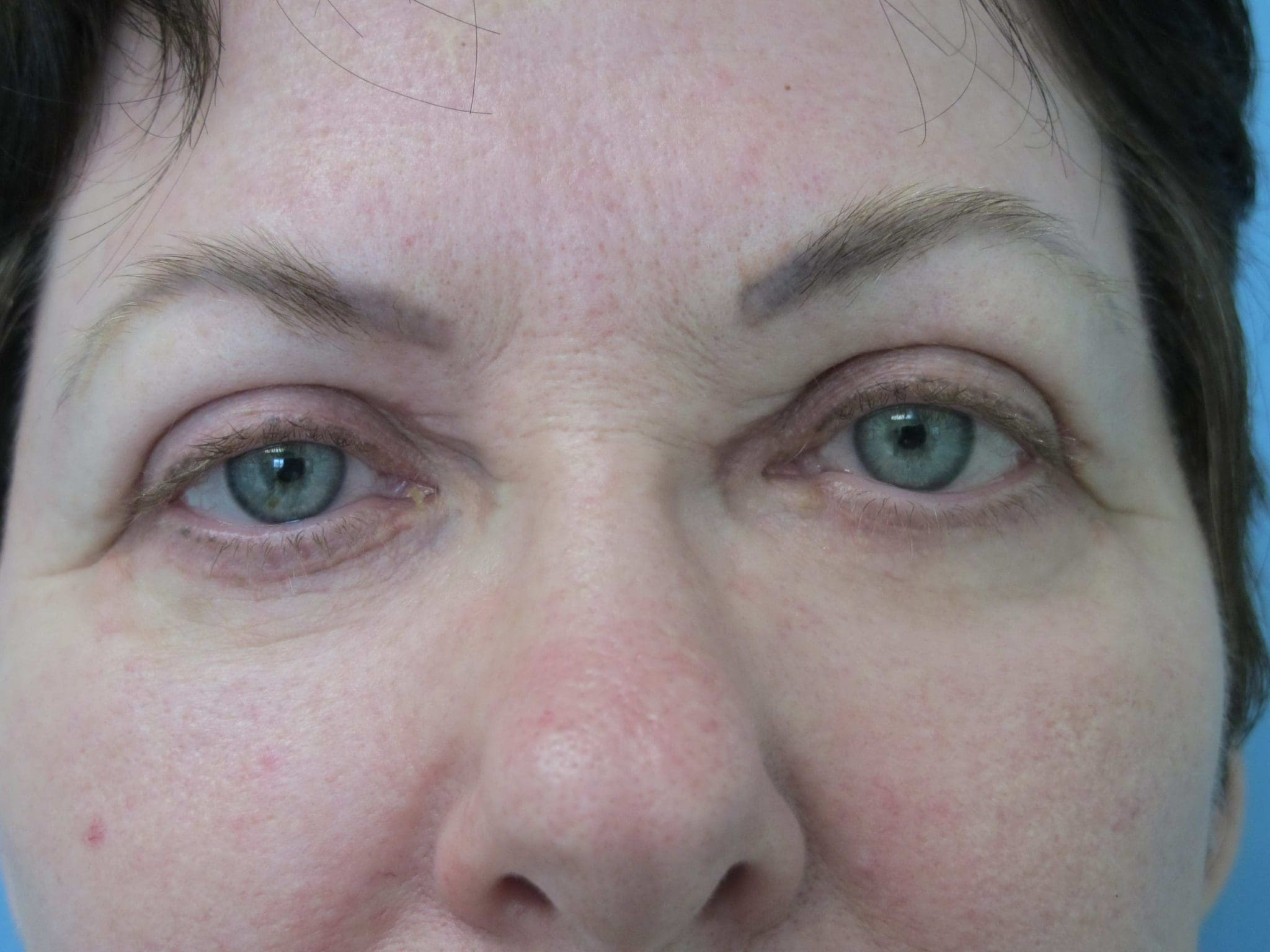 Eyelid Surgery Patient Photo - Case 121 - after view