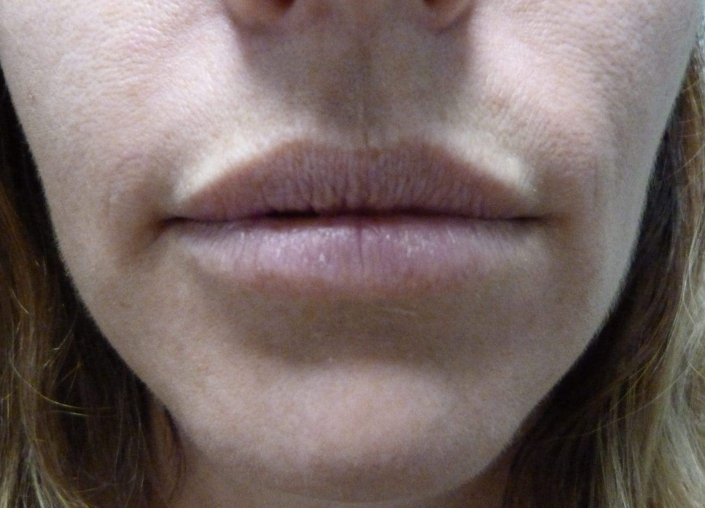 Lip Augmentation Patient Photo - Case 8220 - before view-