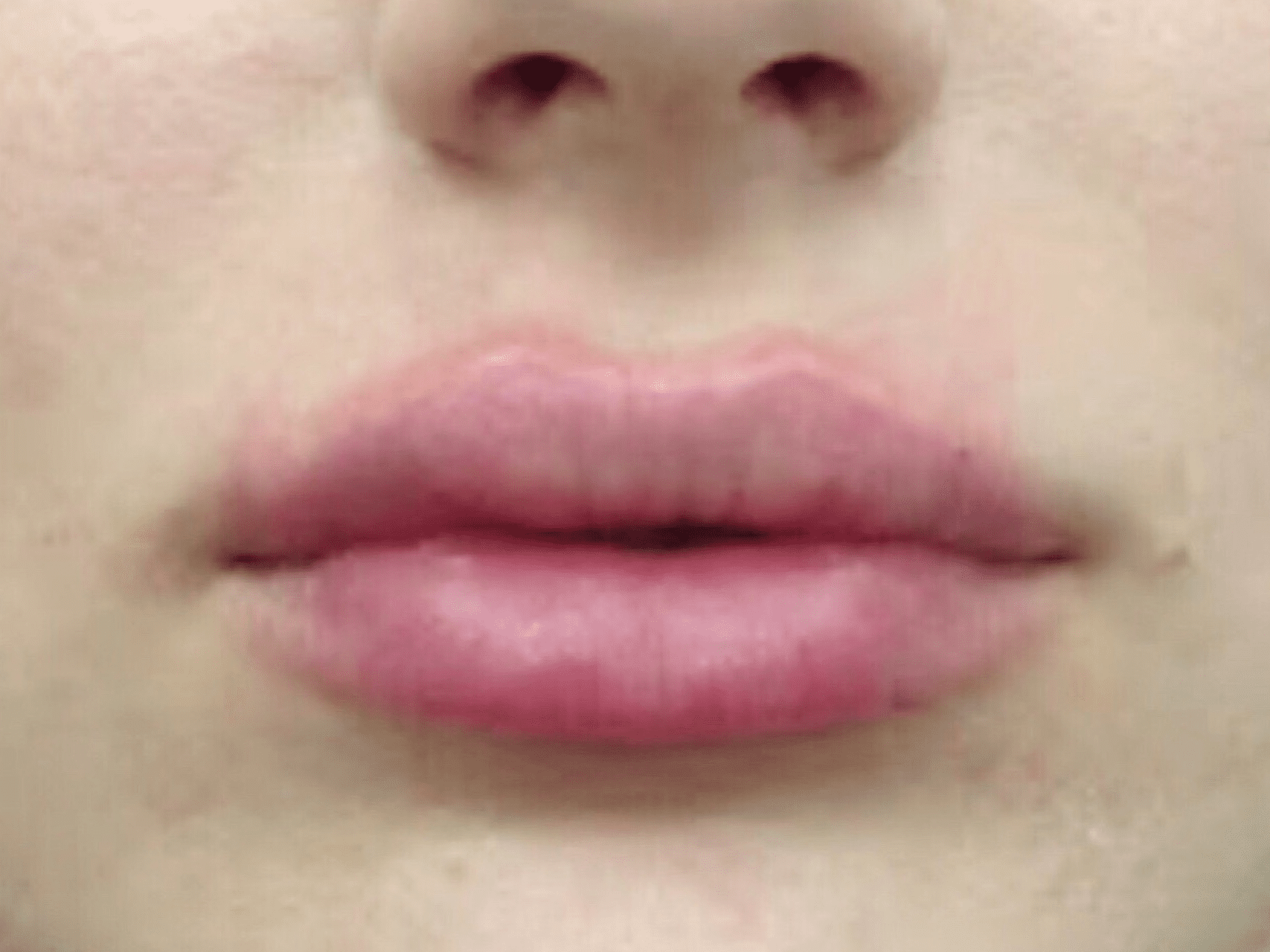 Lip Augmentation Patient Photo - Case 8288 - after view