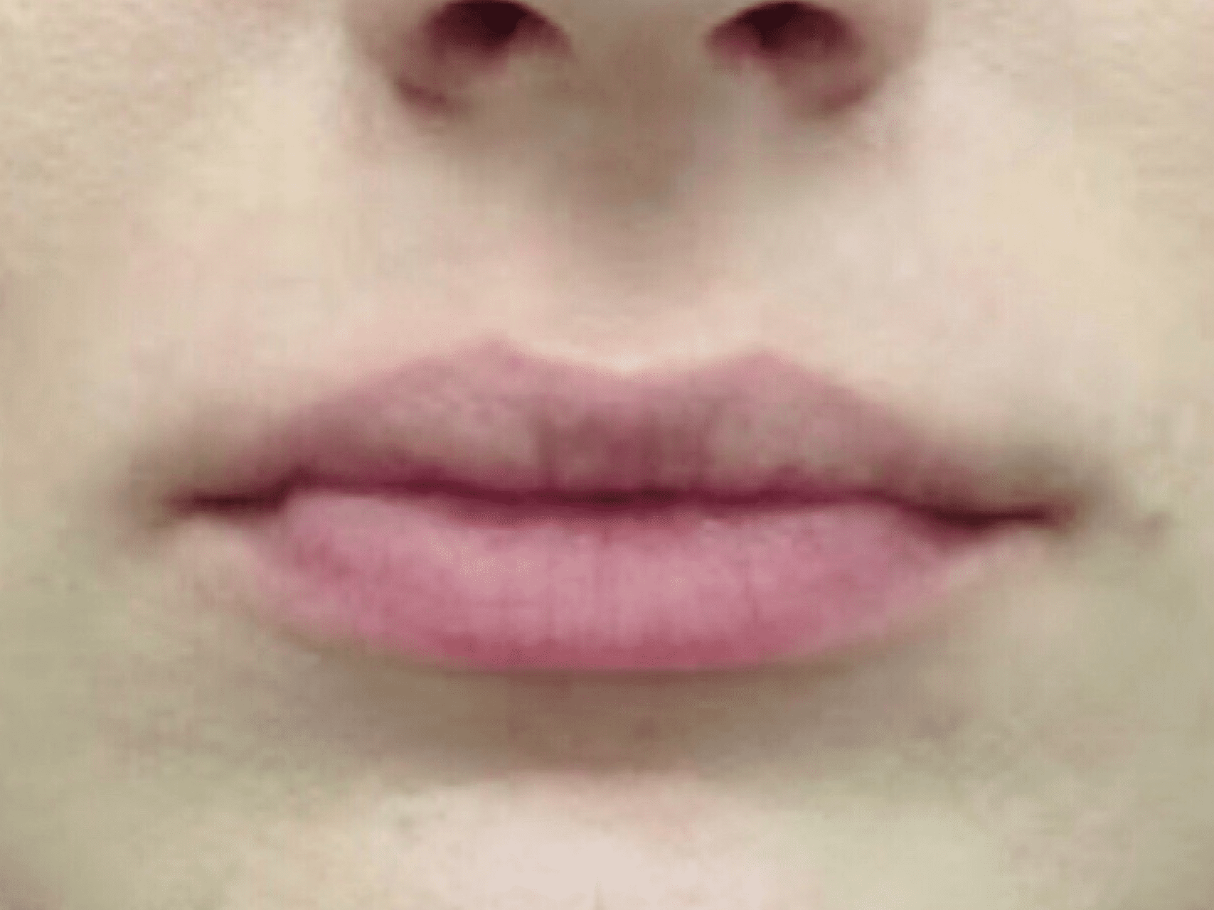 Lip Augmentation Patient Photo - Case 8288 - before view-