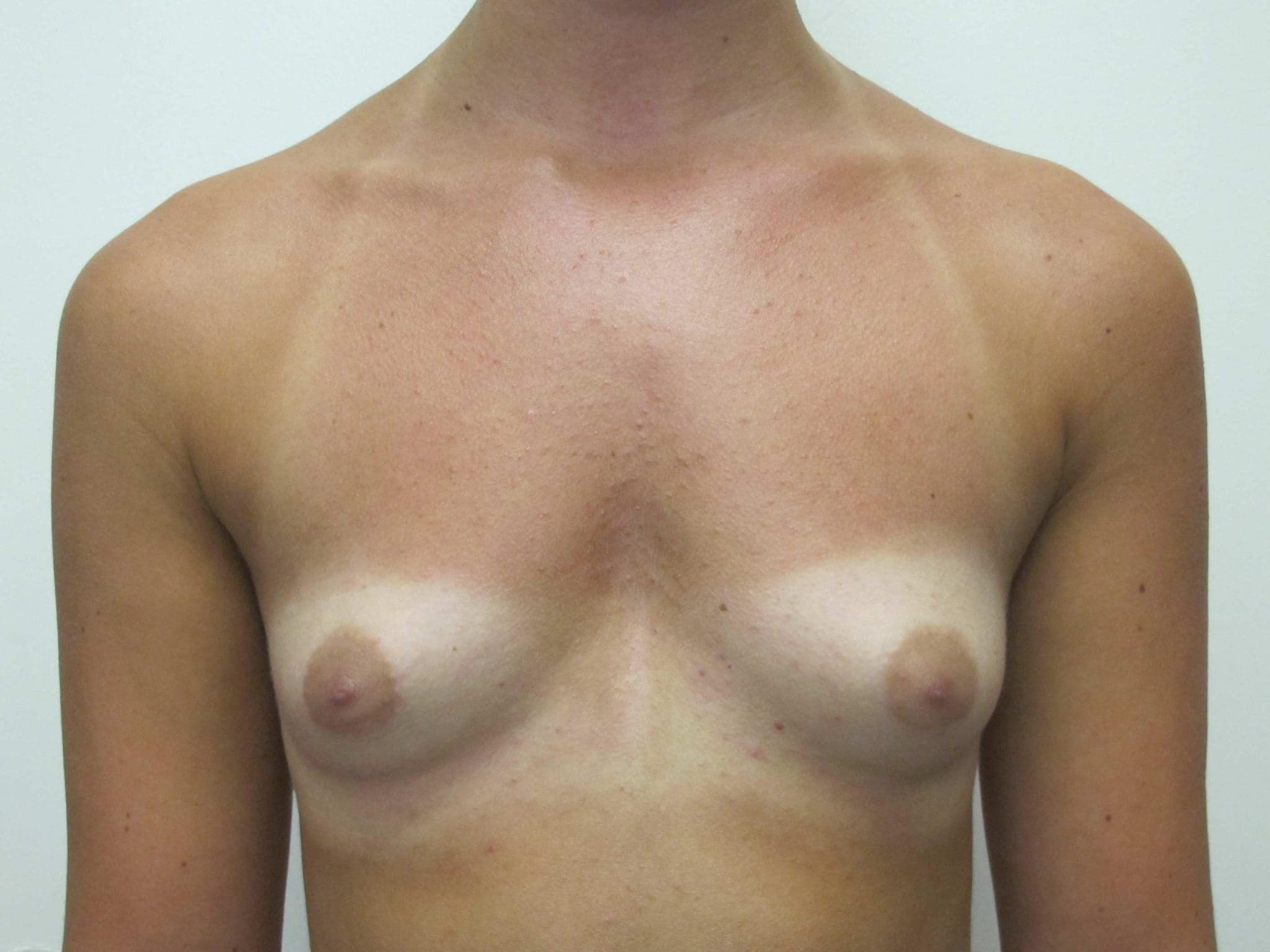 Breast Augmentation Patient Photo - Case 160 - before view-1