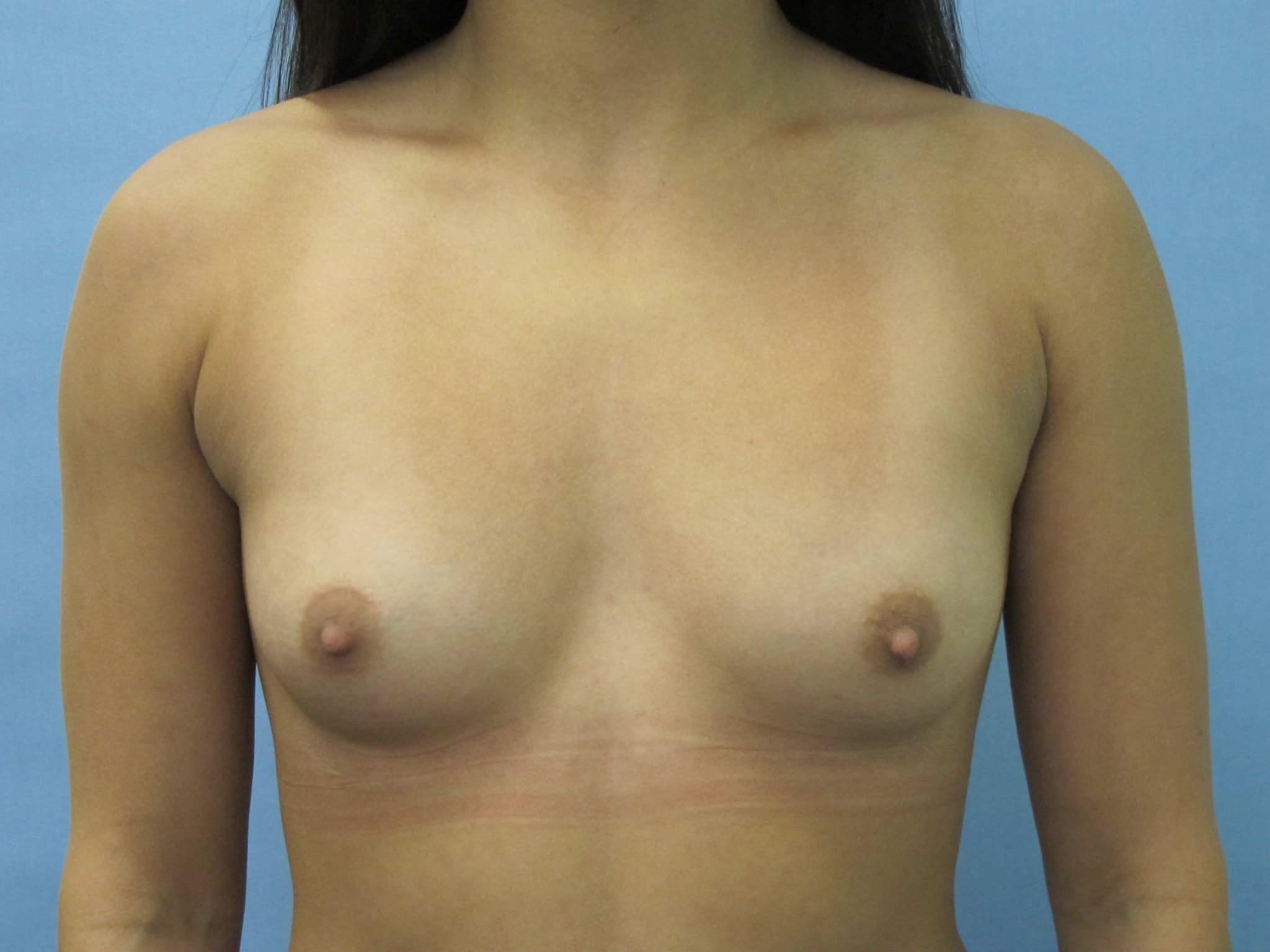 Breast Augmentation Patient Photo - Case 159 - before view-1