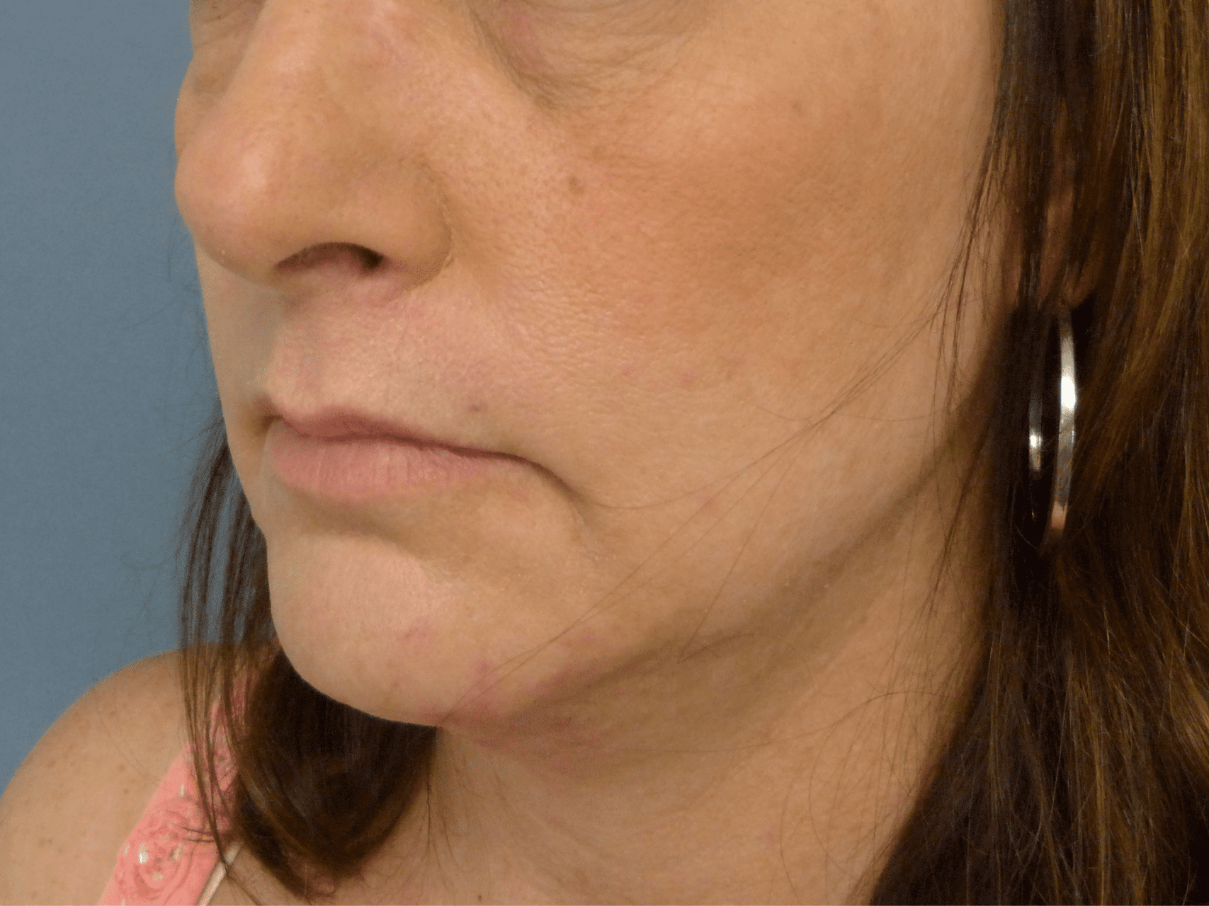 Injectable Fillers Patient Photo - Case 8626 - before view-