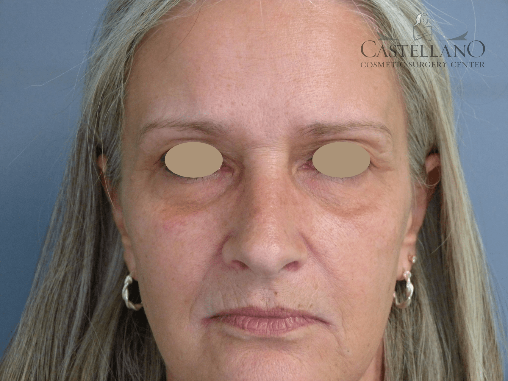 Injectable Fillers Patient Photo - Case 8630 - before view-