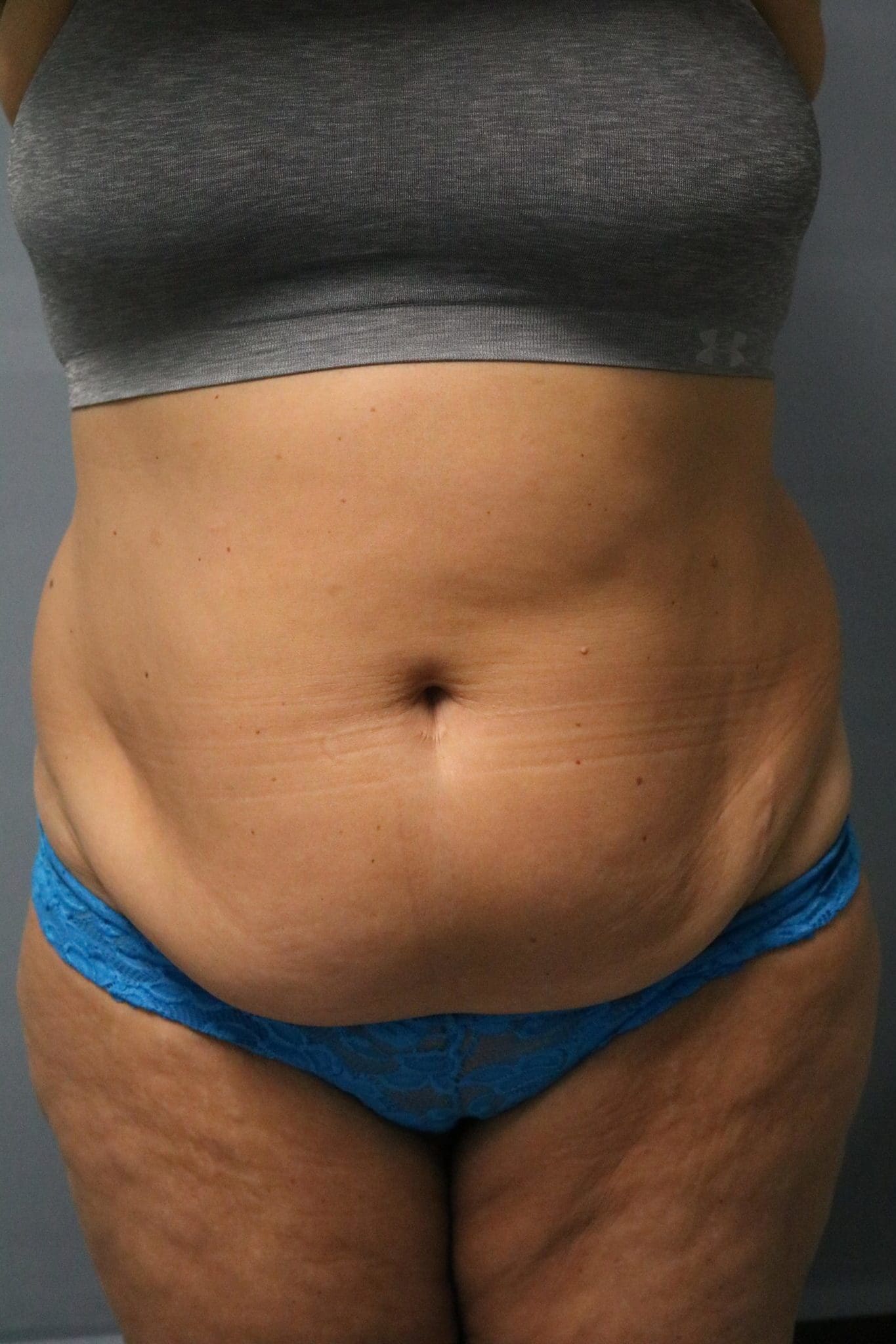 Tummy Tuck Patient Photo - Case 9234 - before view-