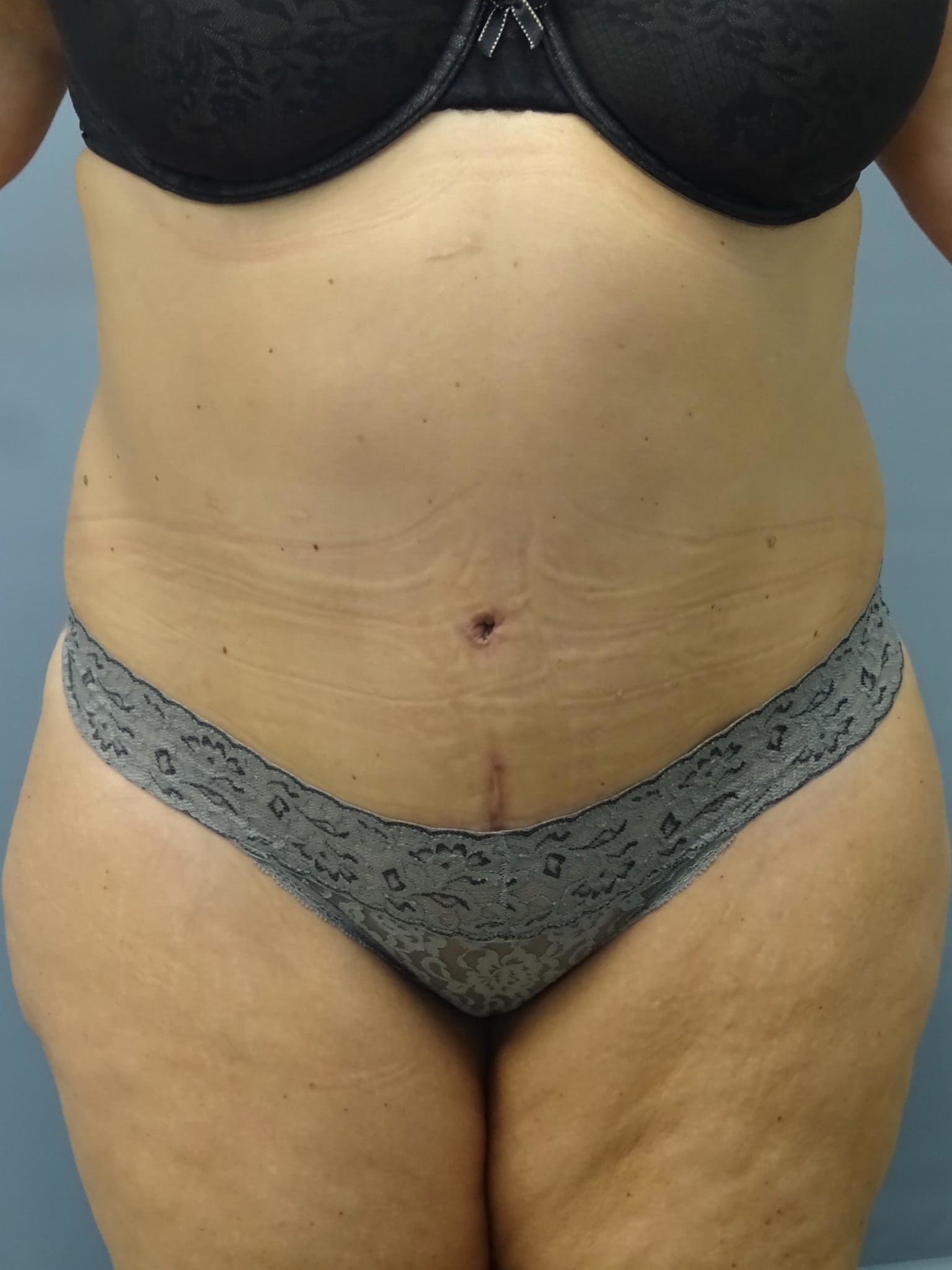 Tummy Tuck Patient Photo - Case 9234 - after view