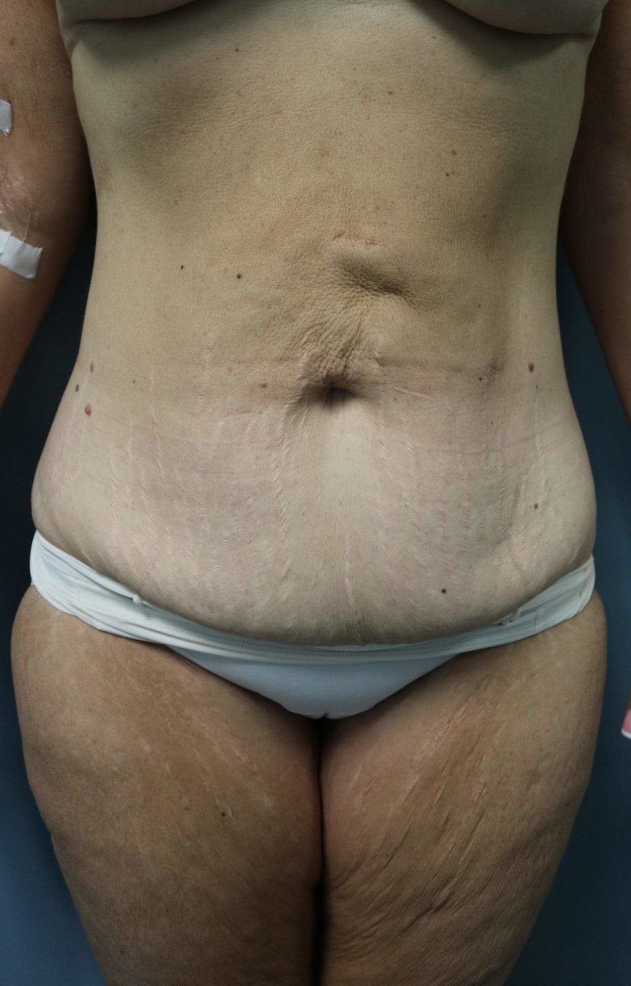 Tummy Tuck Patient Photo - Case 9244 - before view-