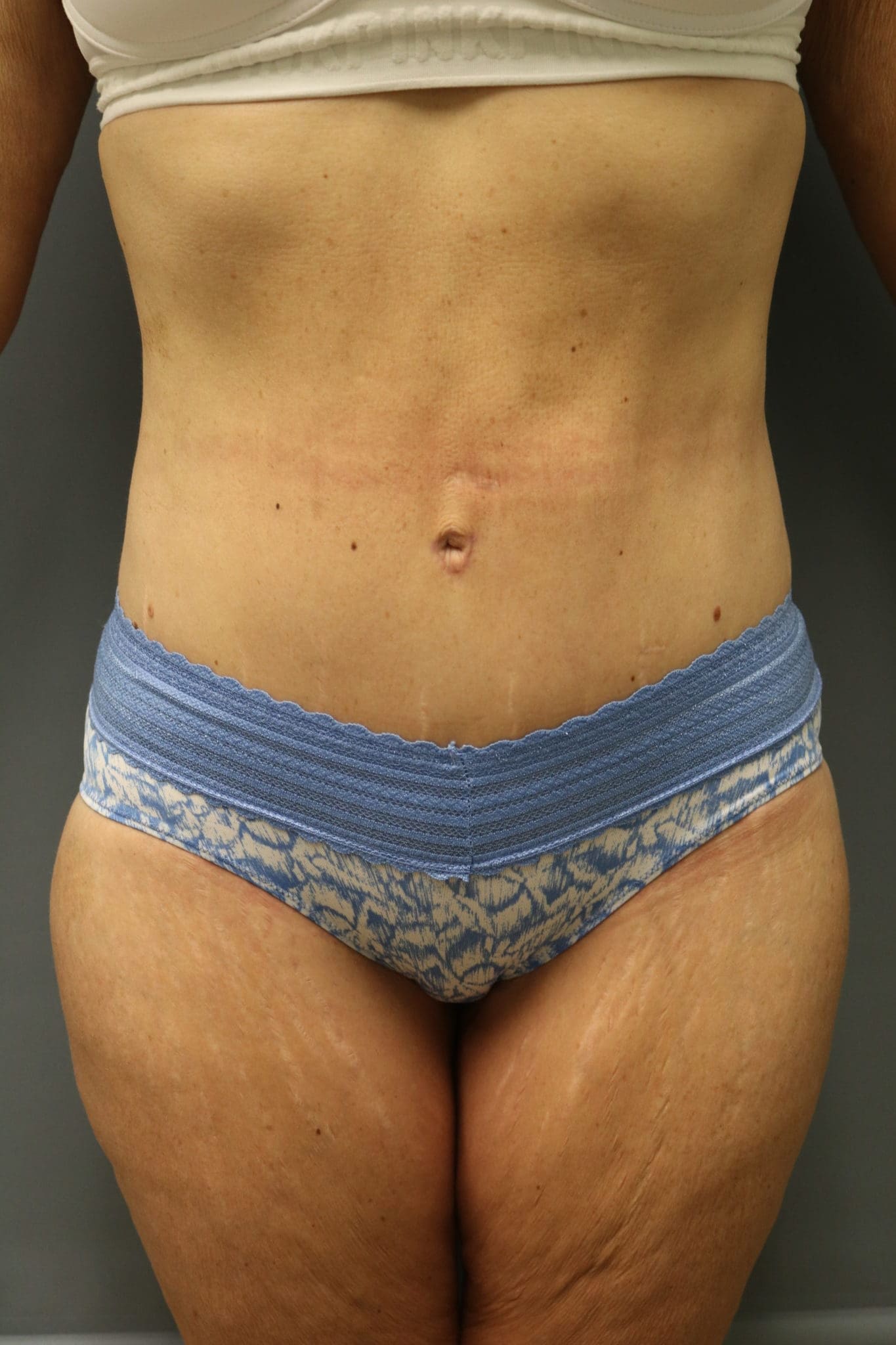 Tummy Tuck Patient Photo - Case 9244 - after view
