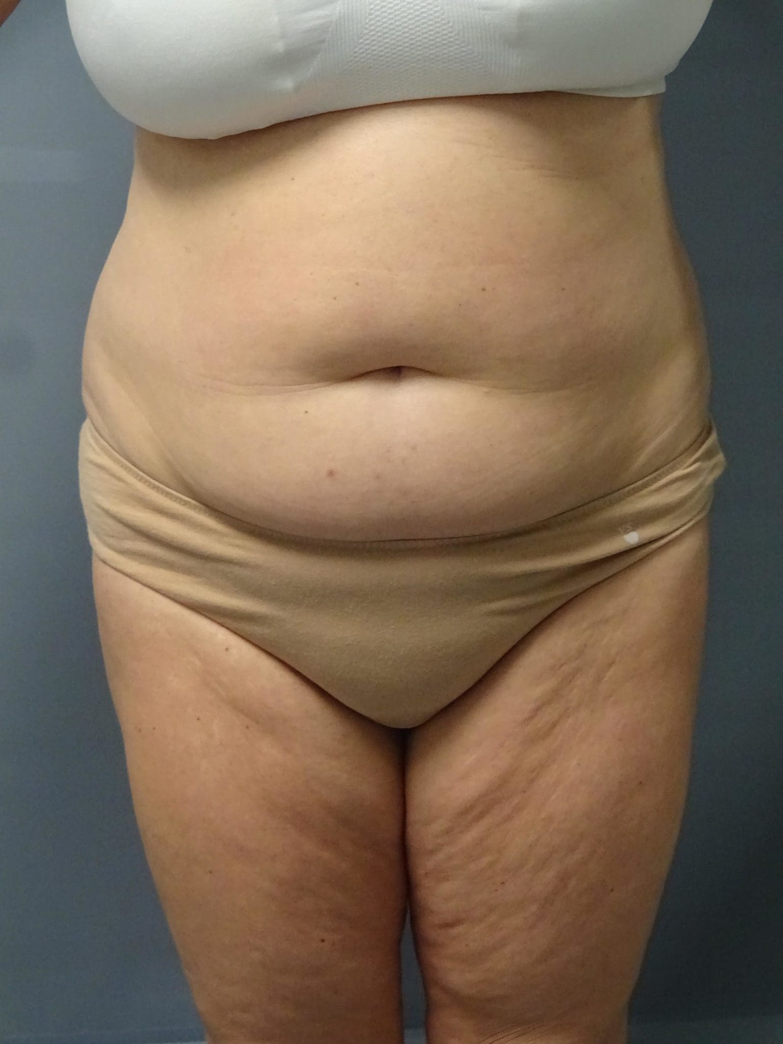 Tummy Tuck Patient Photo - Case 9245 - before view-