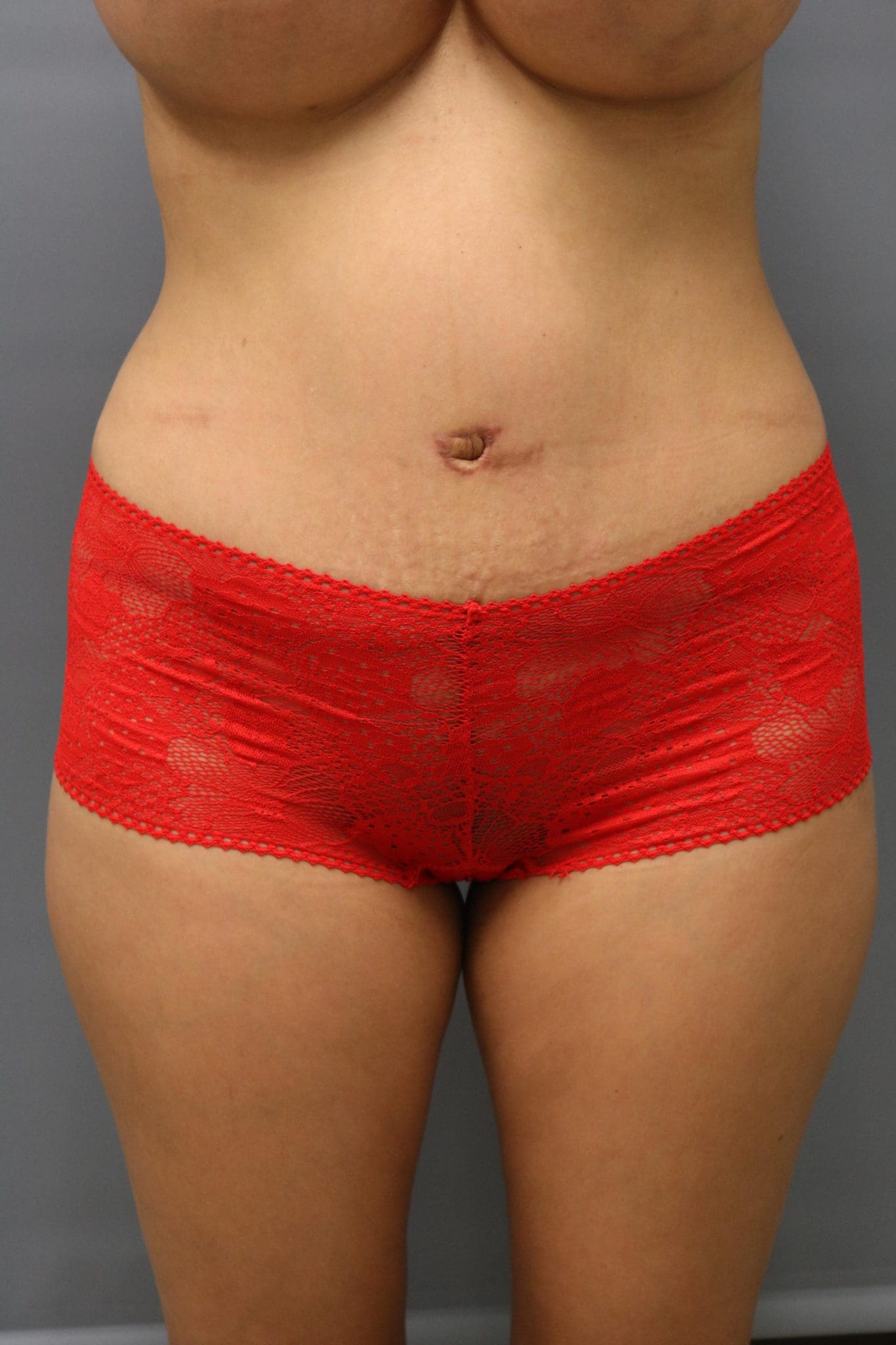 Tummy Tuck Patient Photo - Case 9250 - after view