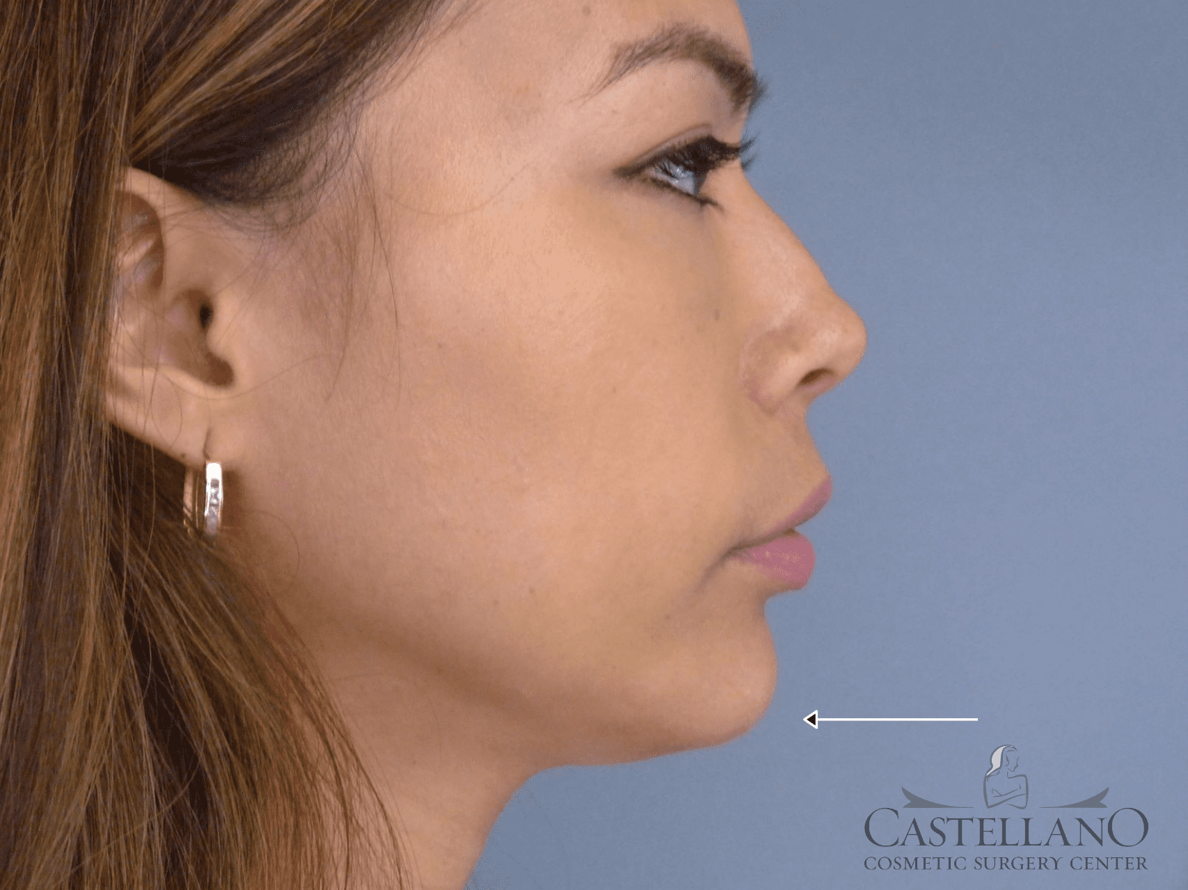 Injectable Fillers Patient Photo - Case 9281 - after view