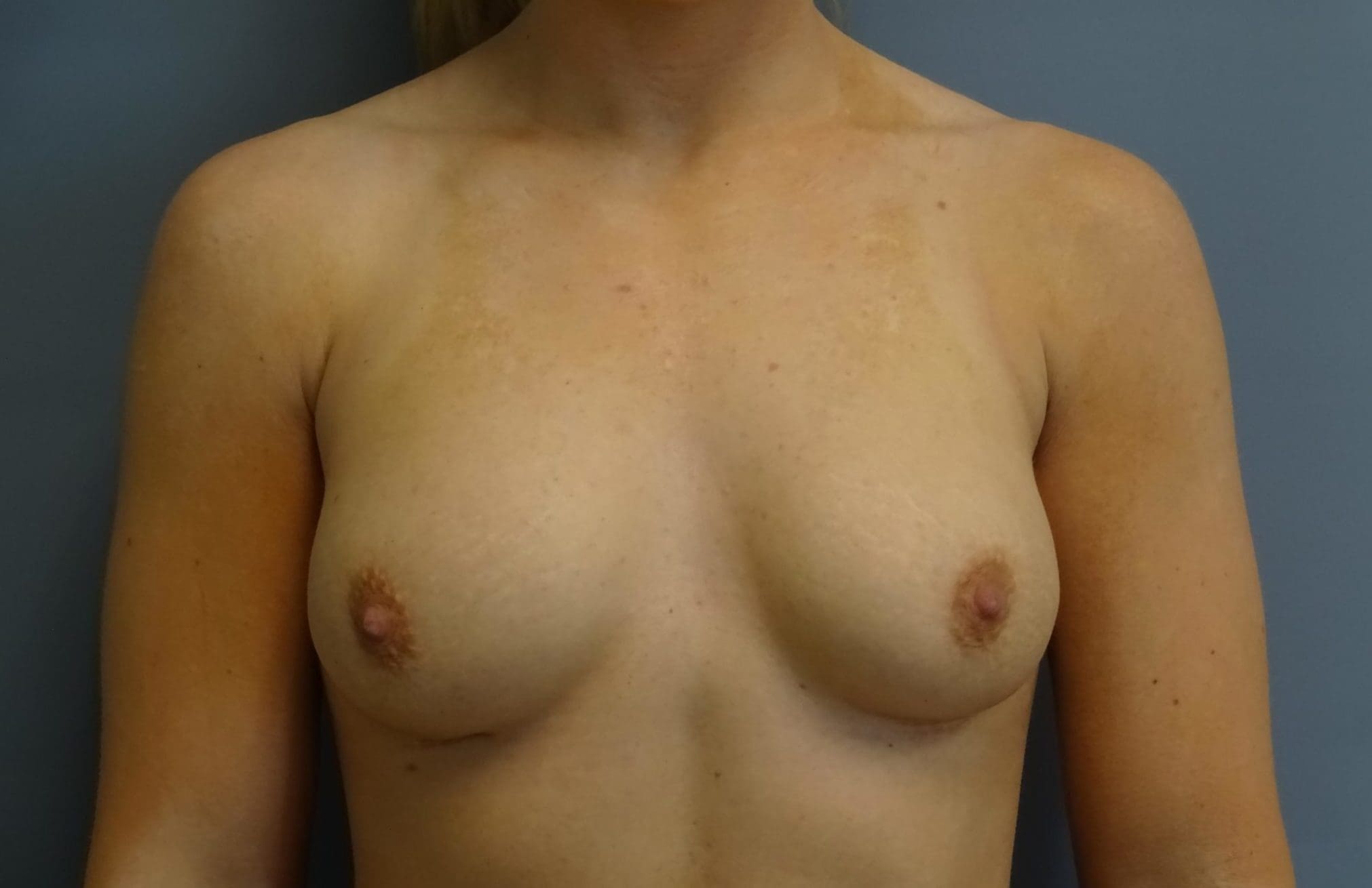 Breast Augmentation Patient Photo - Case 10178 - before view-