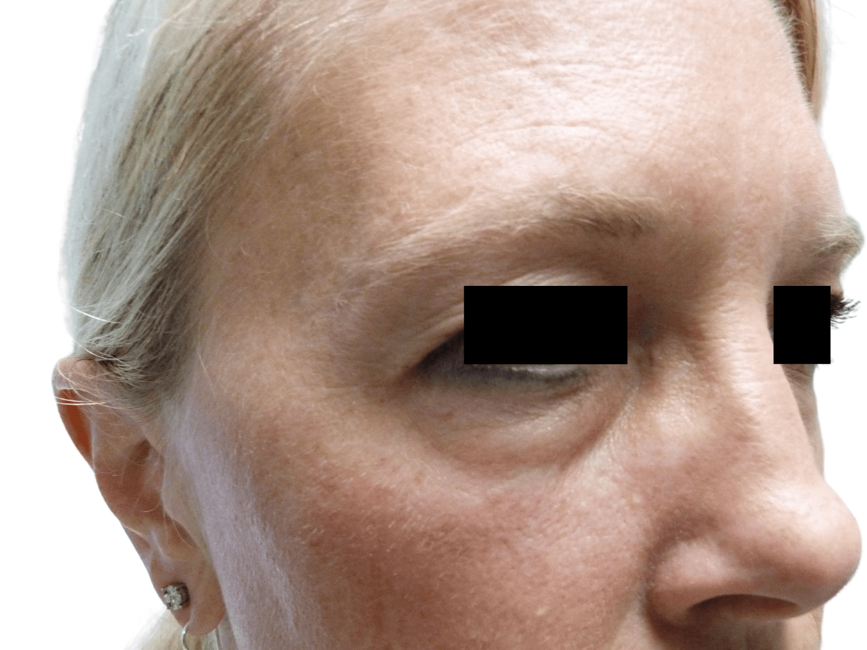 Injectable Fillers Patient Photo - Case 16211 - before view-