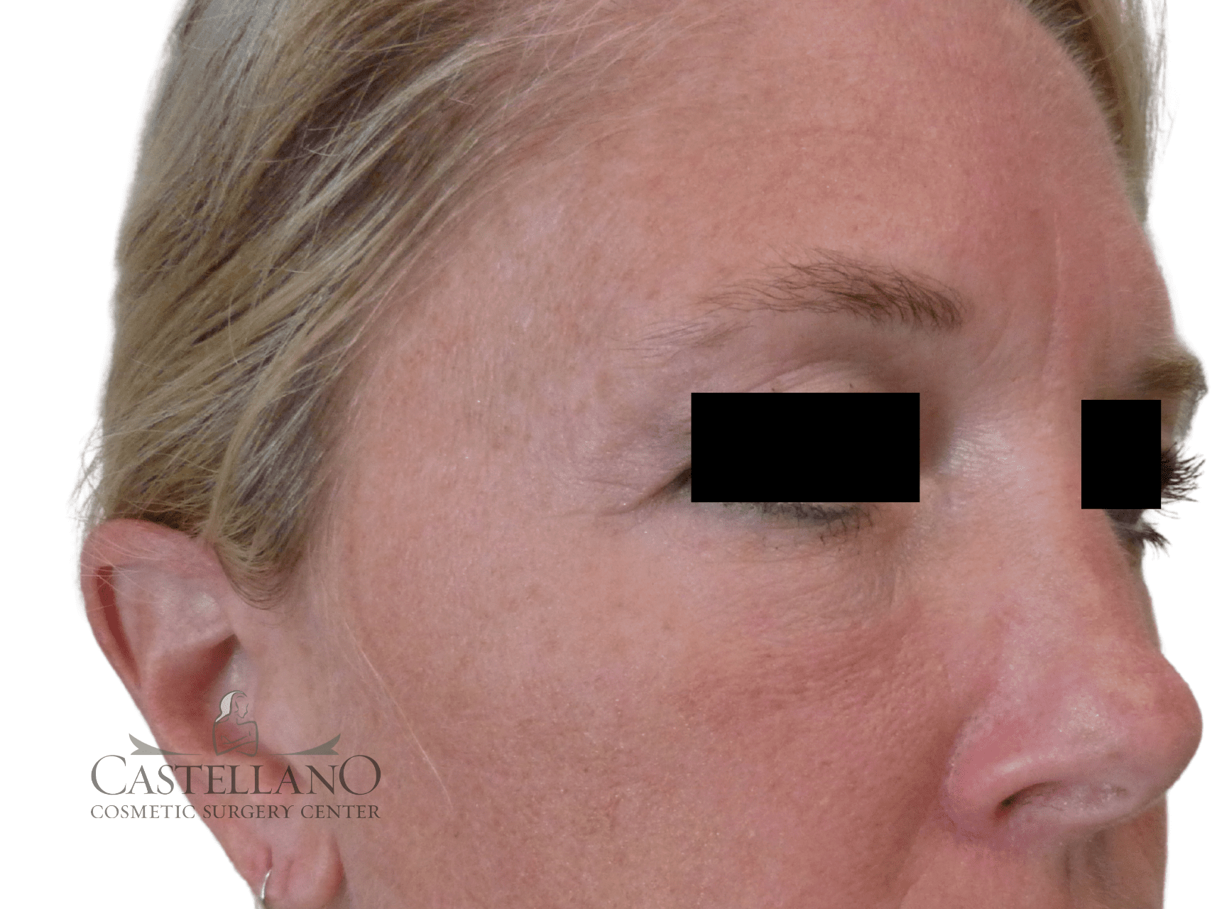 Injectable Fillers Patient Photo - Case 16211 - after view