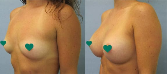 Before and After photos of Breast Augmentation in Tampa