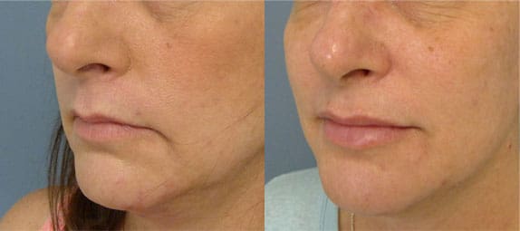 Before and after photos of Injectable Filler in Tampa