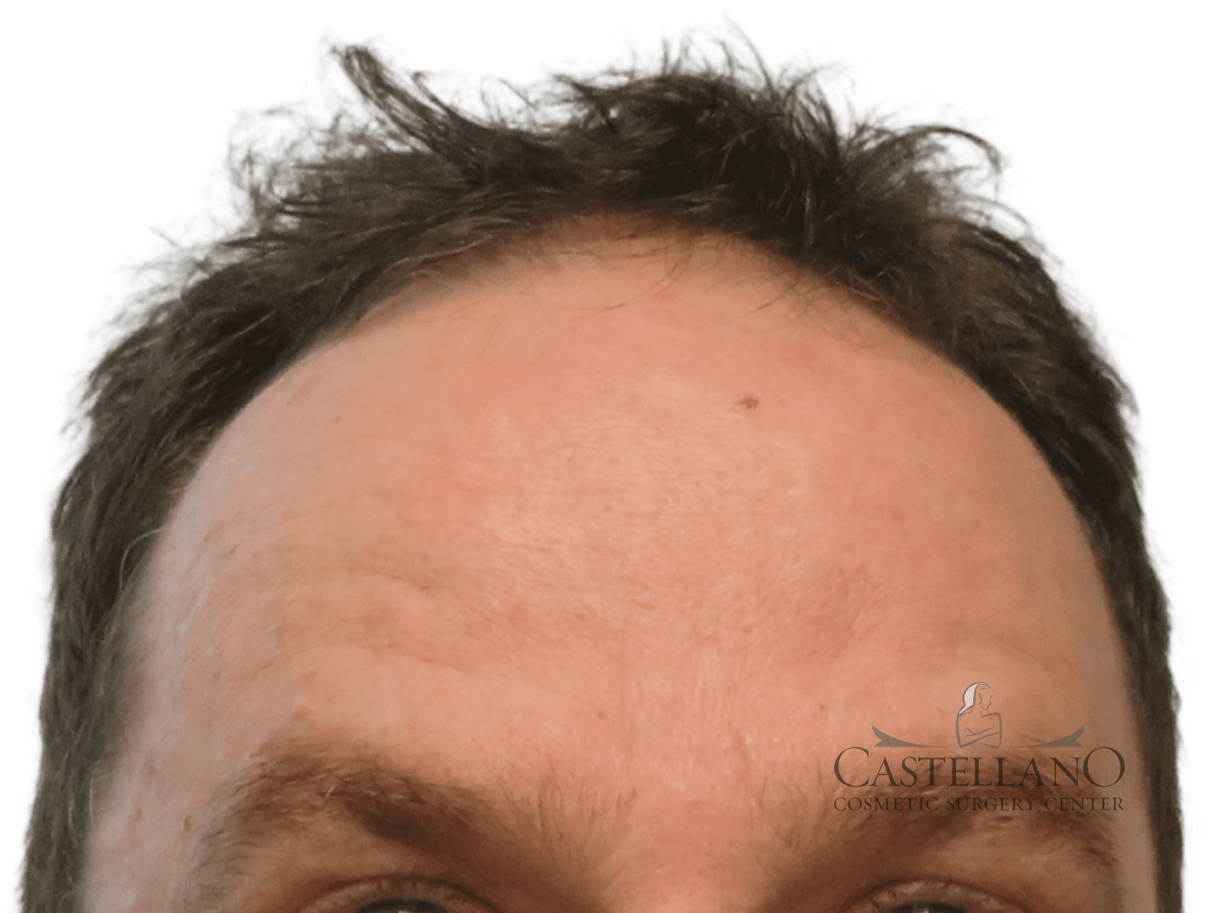 BOTOX® Cosmetic Patient Photo - Case 16743 - after view