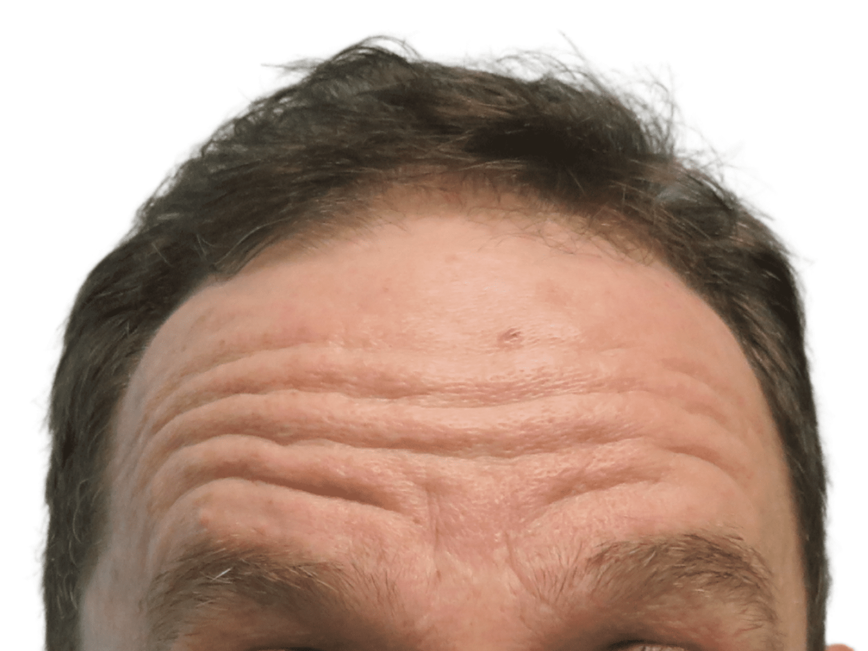BOTOX® Cosmetic Patient Photo - Case 16743 - before view-