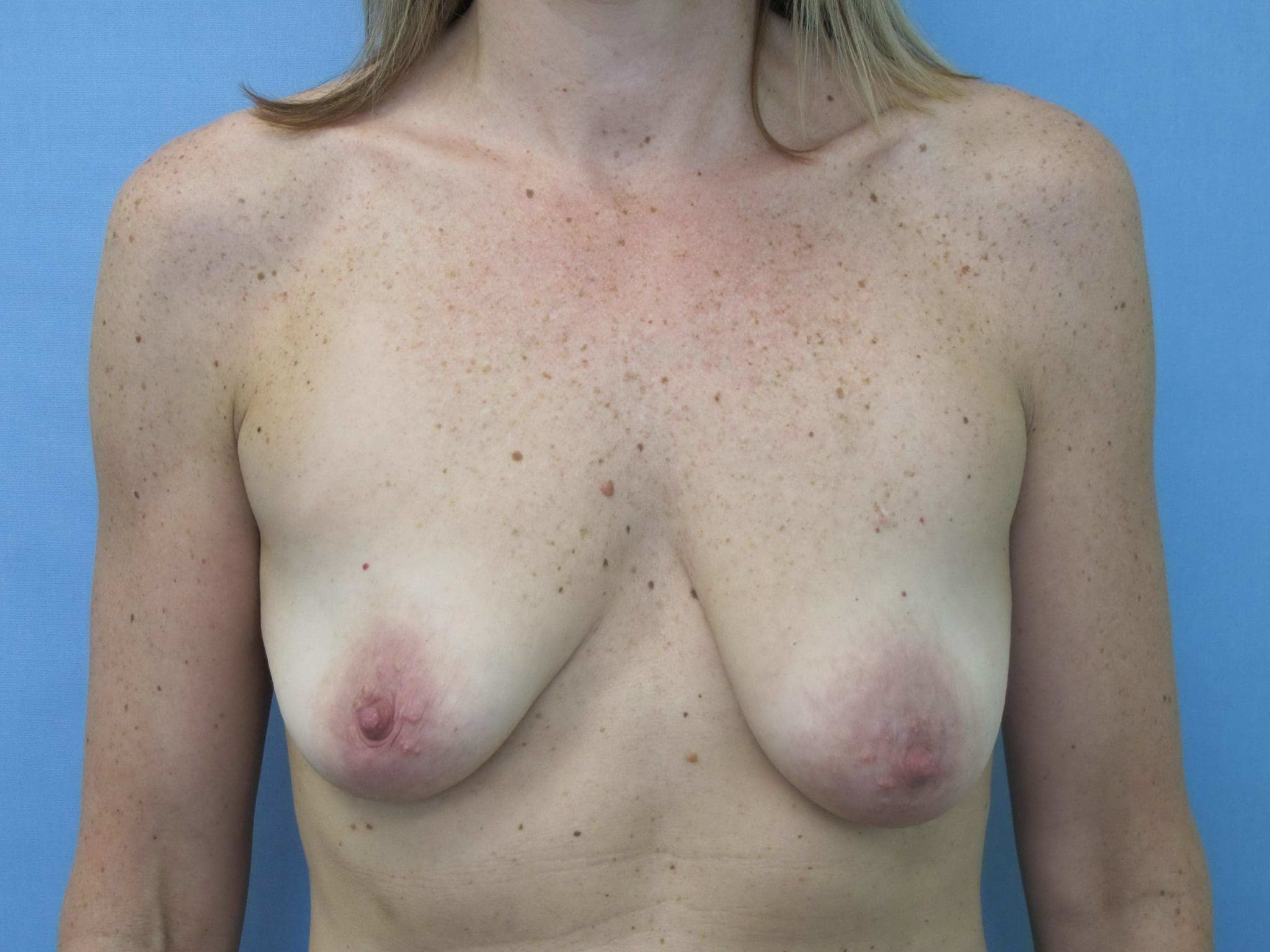 Breast Augmentation Patient Photo - Case 136 - before view-