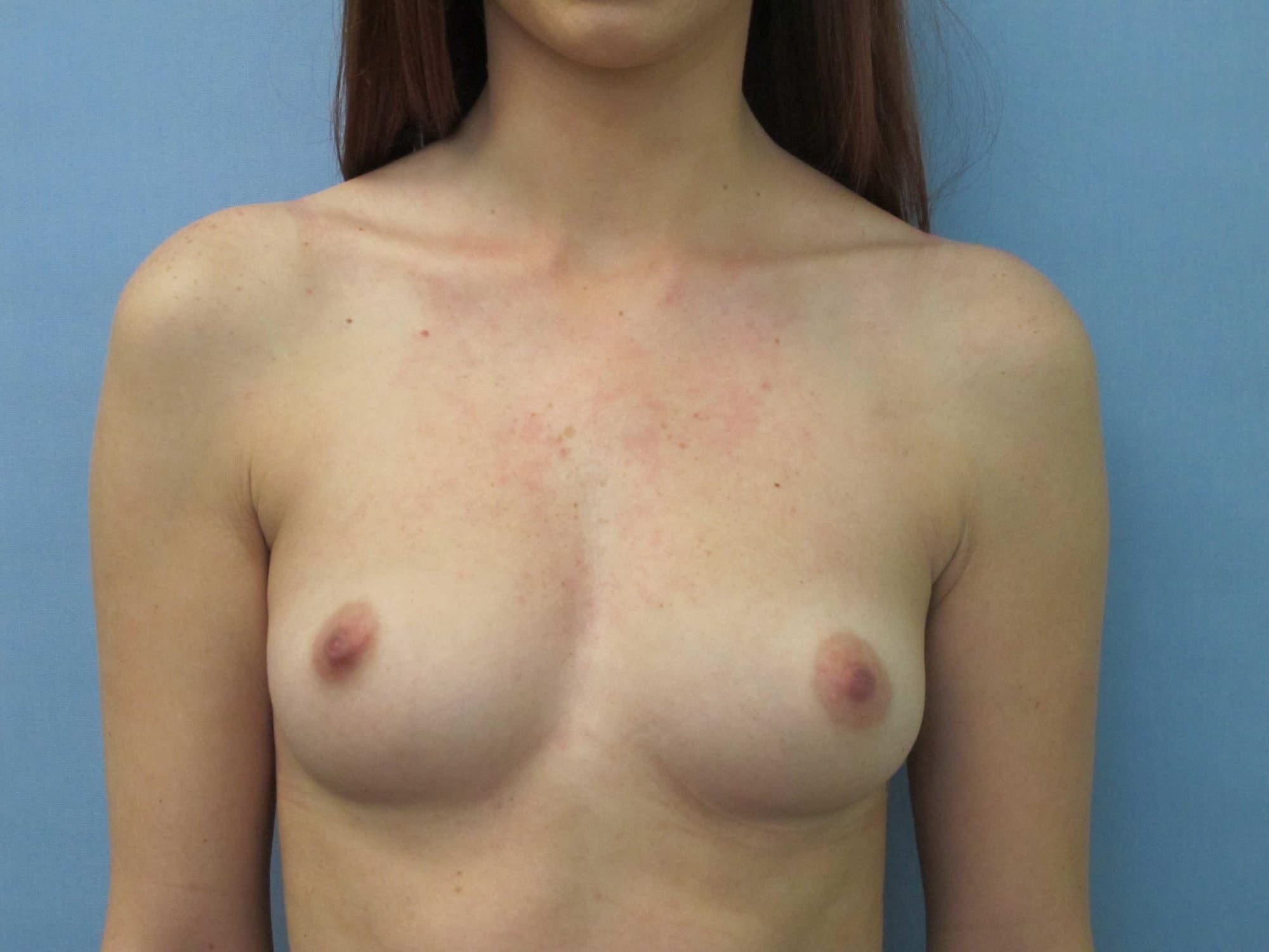 Breast Augmentation Patient Photo - Case 155 - before view-