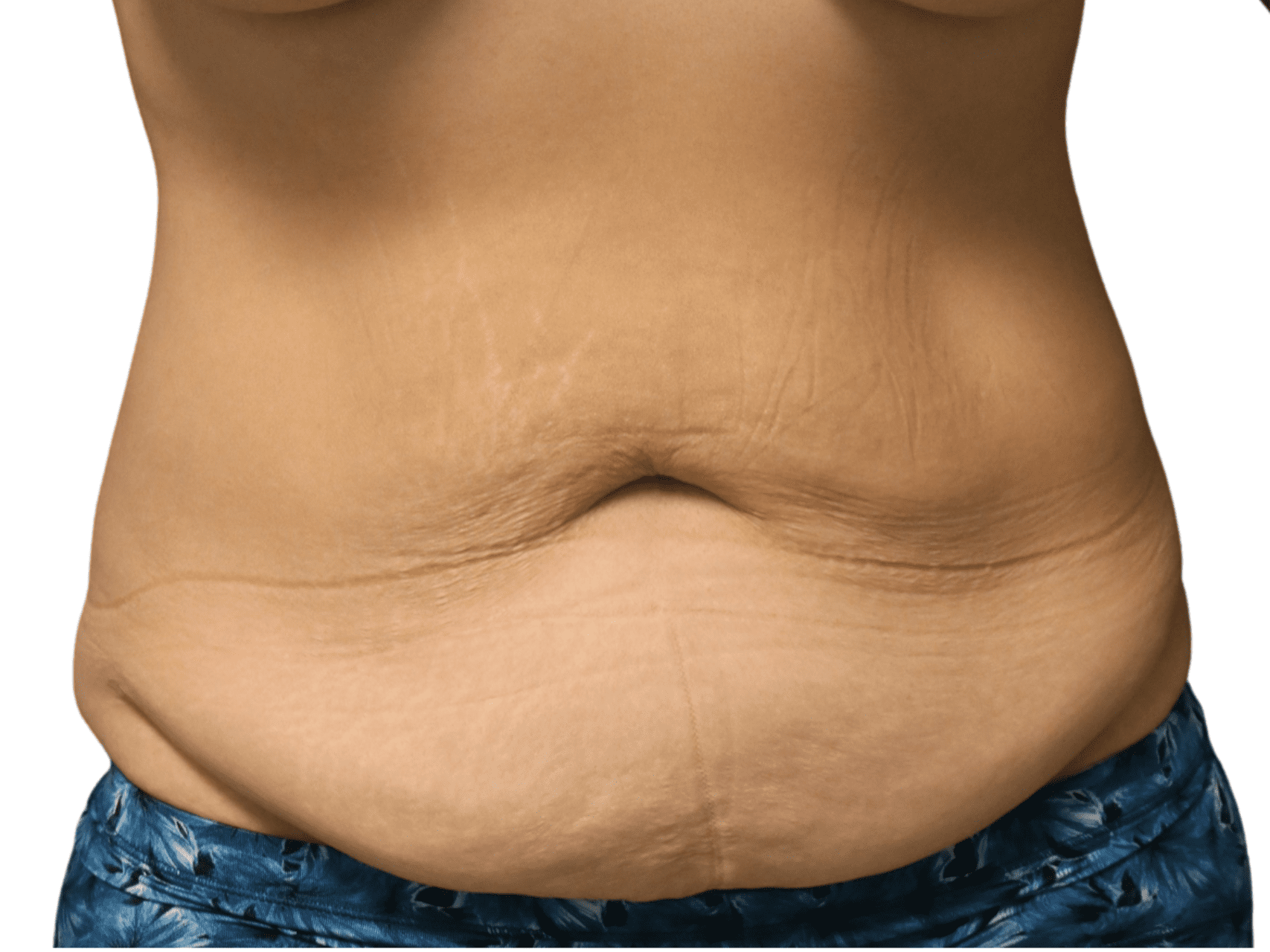 Tummy Tuck Patient Photo - Case 18180 - before view-