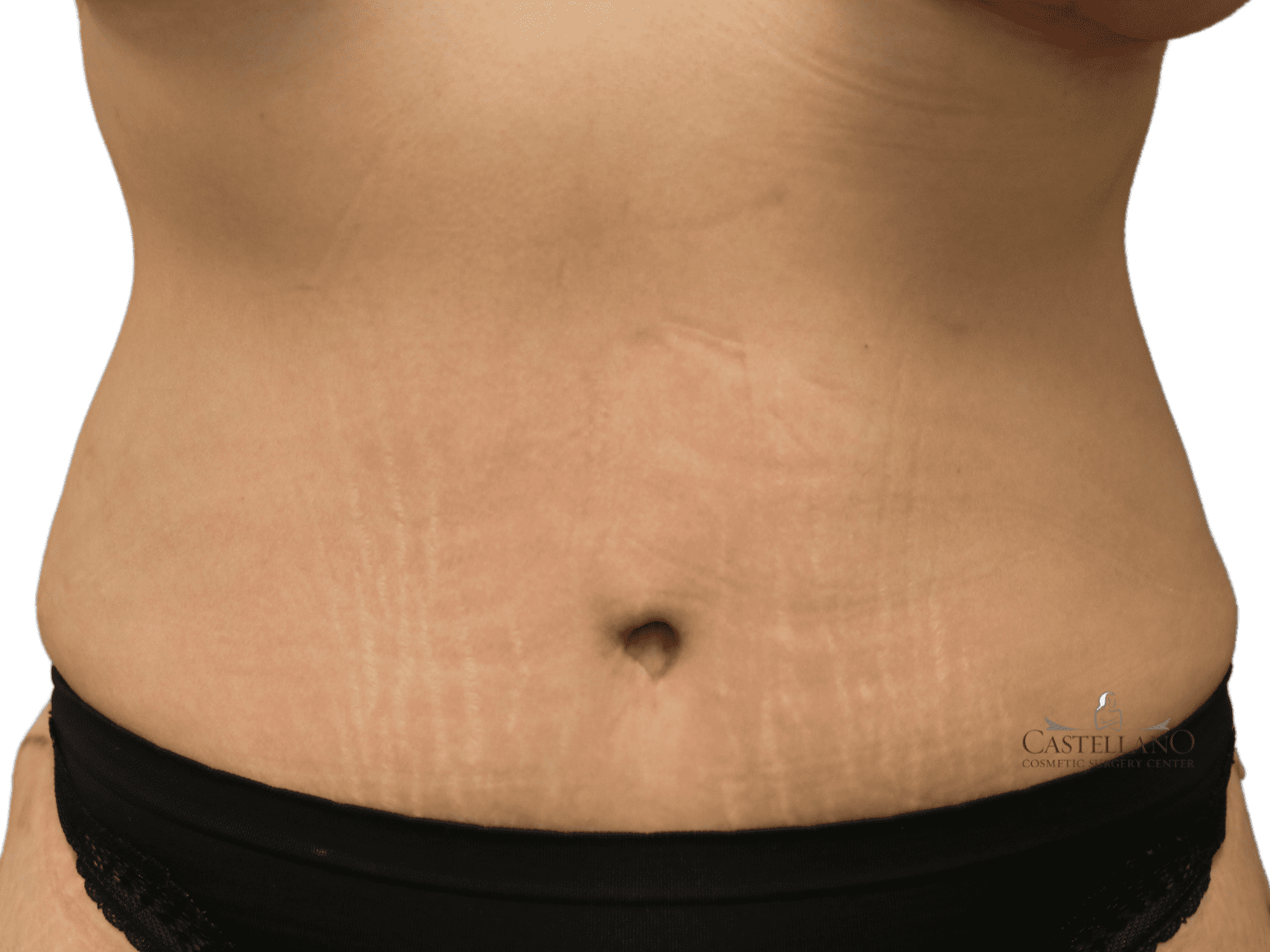 Tummy Tuck Patient Photo - Case 18180 - after view