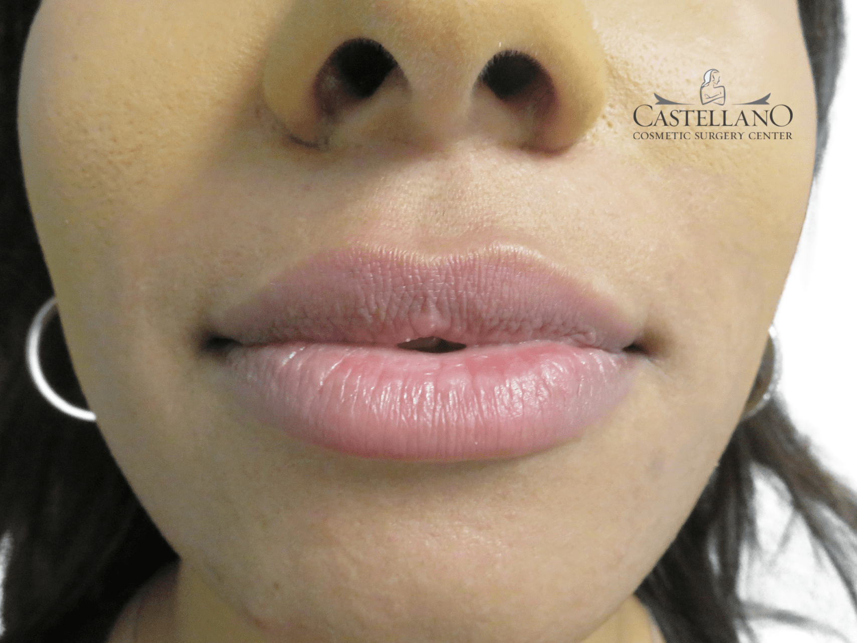 Lip Augmentation Patient Photo - Case 18184 - after view