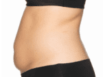 Coolsculpting® - Case 18241 - Before
