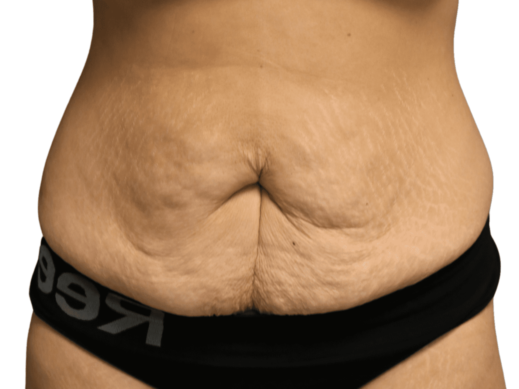 Tummy Tuck Patient Photo - Case 18859 - before view-