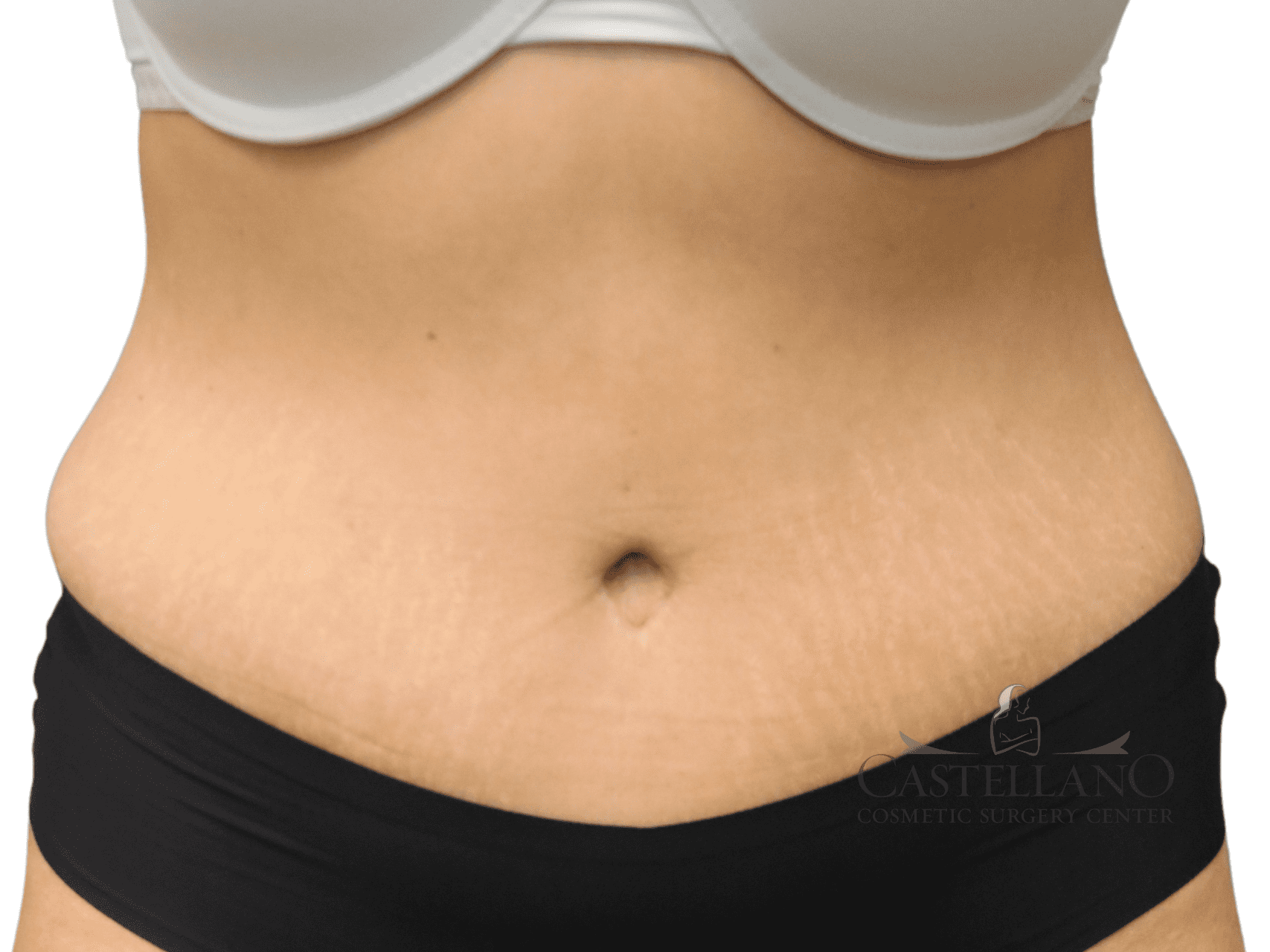 Tummy Tuck Patient Photo - Case 18859 - after view