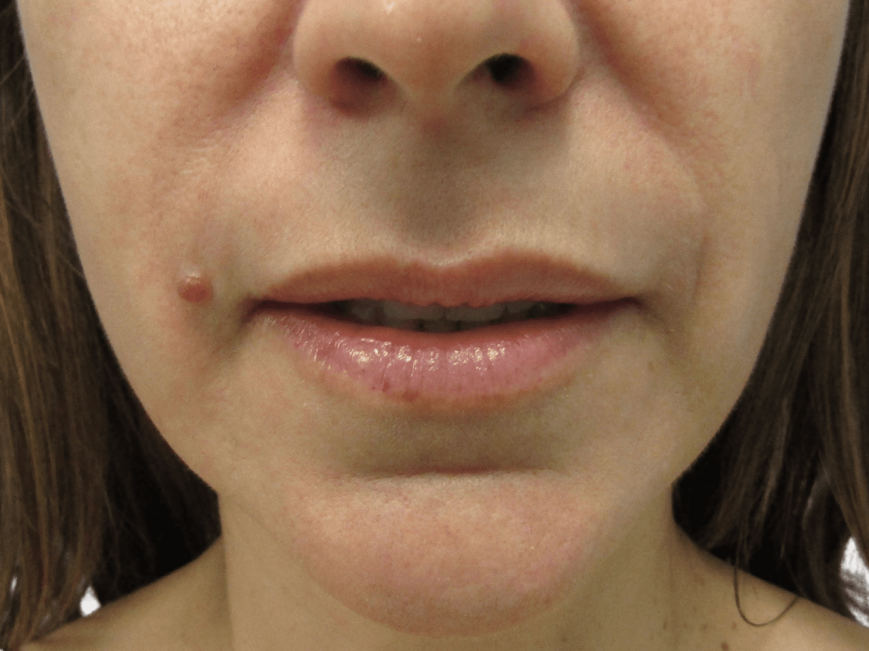 Lip Augmentation Patient Photo - Case 18886 - before view-