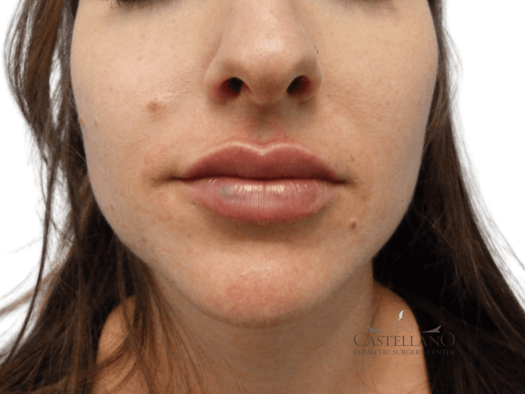 Lip Augmentation Patient Photo - Case 18928 - after view