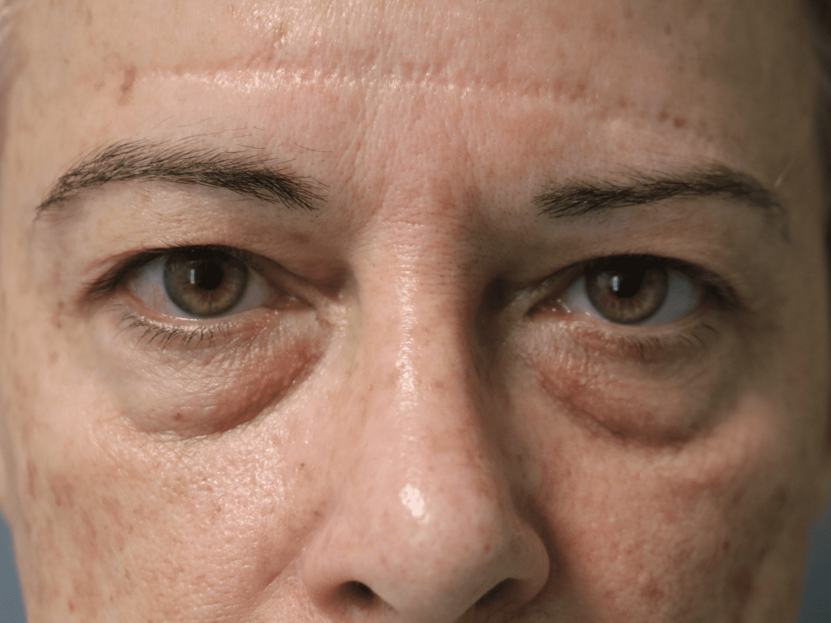 Eyelid Surgery Patient Photo - Case 19032 - before view-