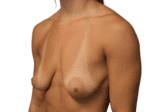 Breast Lift with Augmentation - Case 19065 - Before