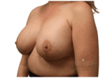 Breast Lift with Augmentation - Case 19097 - After