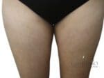 Liposuction - Case 19108 - After