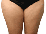 Liposuction - Case 19108 - Before