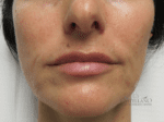 Lip Augmentation - Case 19116 - After