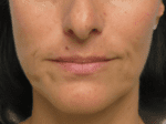 Lip Augmentation - Case 19116 - Before