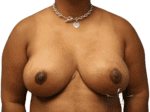 Breast Reduction - Case 19200 - After