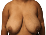 Breast Reduction - Case 19200 - Before